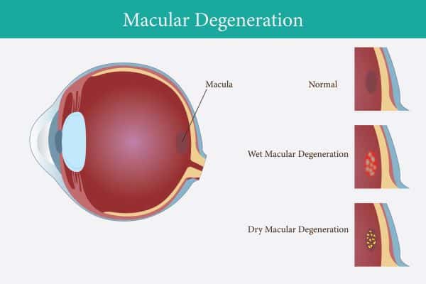 Imagem do globo ocular com destaque para a mácula que apresenta Degeneração macular relacionada à idade - DMRI