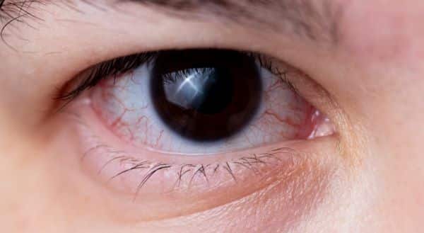 Olho escuro demonstrando crescimento anormal de vasos sanguíneos, uma característica de DMRI.