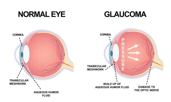 Glaucoma é um dos exames oculares que pode detectar o glaucoma. Na imagem, a anatomia do globo ocular normal e com glaucoma.