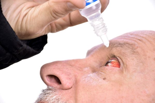 Homem maduro, com bigode branco, está pingando colírio em um olho vermelho injetado de sangue. Conceito de alergias oculares no verão