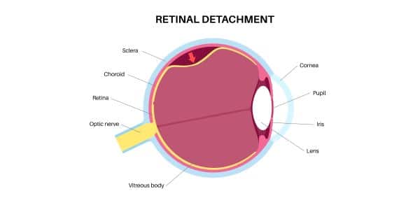 Descolamento de retina mostrado em vetor de olho humano.