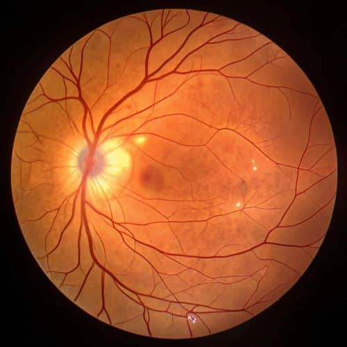 Fundo da retina humana normal.
