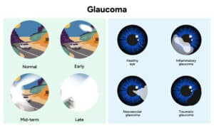 Imagens representativas de visão normal e visão com glaucoma.