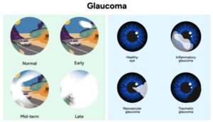 Imagens representativas de visão normal e visão com glaucoma.