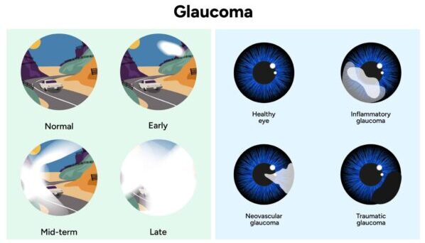 Imagens representativas de visão normal e visão com glaucoma.