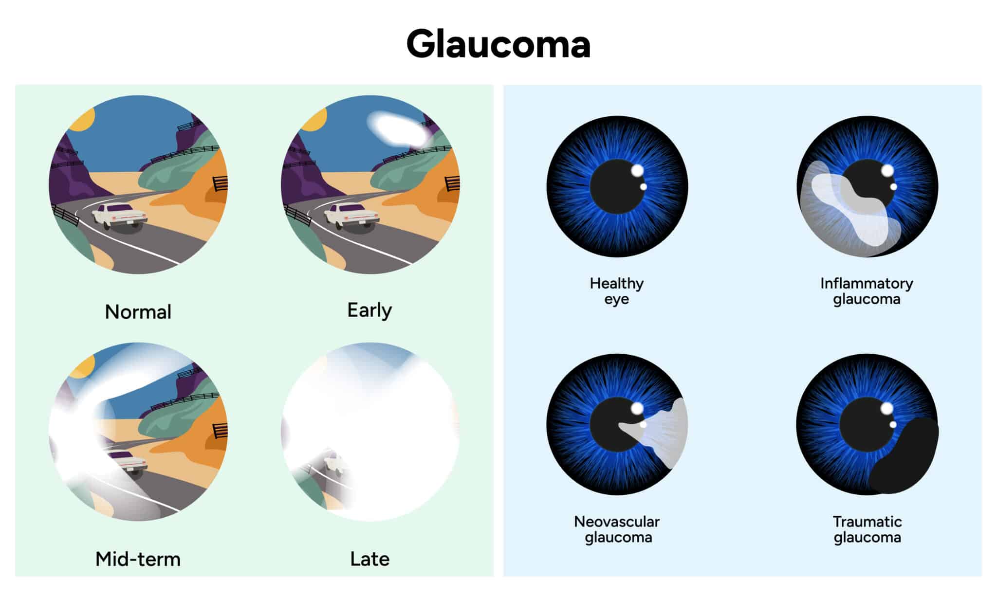 Imagens representativas de visão normal e visão com glaucoma.