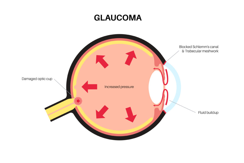 Vetor infográfico indicando como a pressão intraocular provoca o glaucoma.
