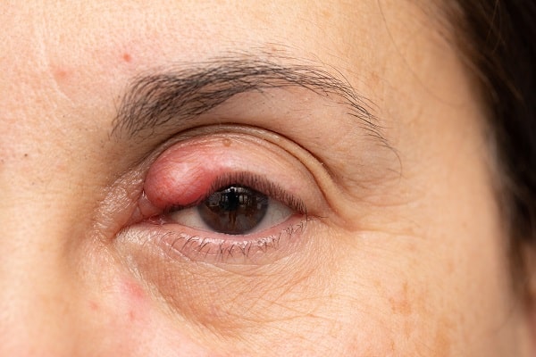 Olho castanho de mulher que apresenta inflamação na pálpebra superior esquerda - típico calázio.