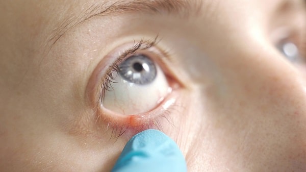 Close dos olhos azuis de uma mulher que apresenta terçol no olho direito.