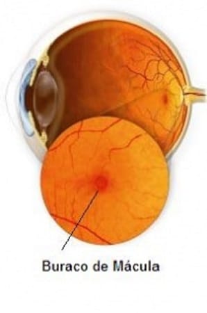 Imagem do globo ocular destacando o buraco macular na região central da retina.