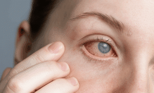 Close do olho direito de uma mulher, o qual apresenta vermelhidão característica do olho seco neurogênico.