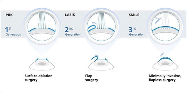 Técnicas de cirurgia refrativa: Lasik, PRK e Smile.