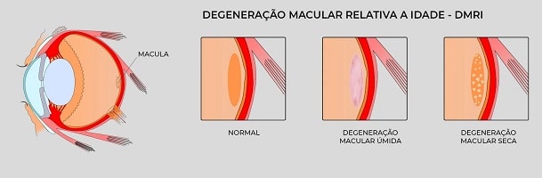 4 imagens ilustrativas sobre dmri : globo ocular com destaque pra mácula - olho normal - olho com dmri úmida - olho com dmri seca