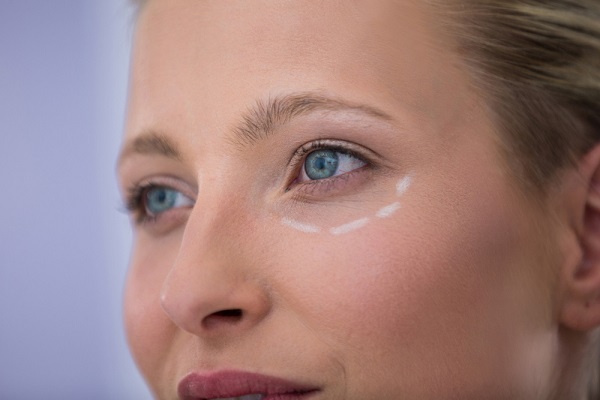 Close do rosto de uma mulher que está com os olhos marcados para a realização de blefaroplastia.