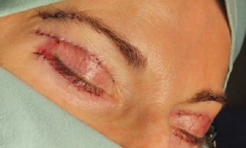 Close dos olhos de paciente que foi submetida à blefaroplastia superior e inferior.  Neles percebem-se as suturas recém feitas. 
O pós-operatório de cirurgia plástica ocular requer muito cuidado e paciência.