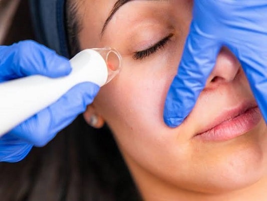 Paciente jovem fazendo tratamento com o  laser de CO₂ ao redor dos olhos. 